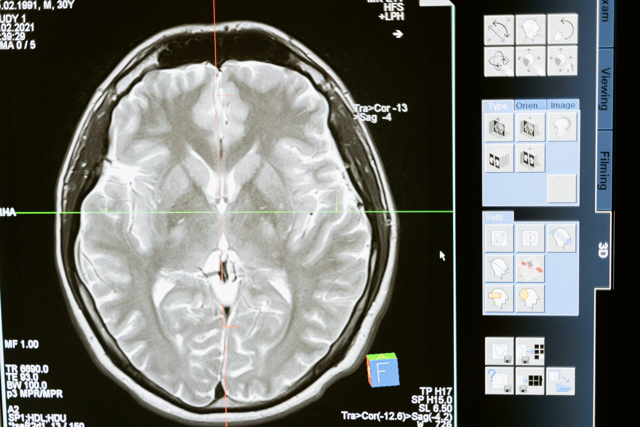 Imagerie du cerveau Imagerie médicale